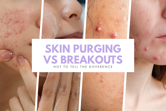 Skin Purging vs Breakouts: How to Tell the Difference