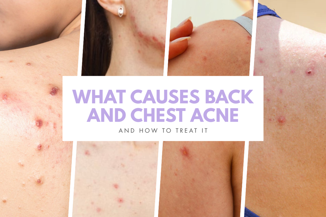 What Causes Back and Chest Acne (and How to Treat It)