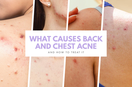 What Causes Back and Chest Acne (and How to Treat It)