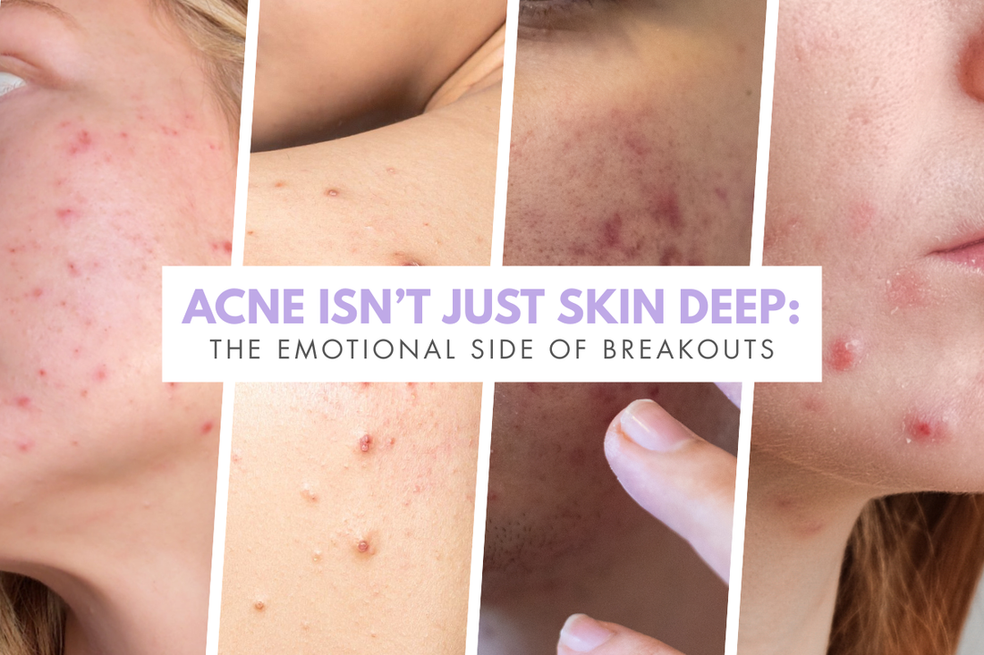 Acne Isn’t Just Skin Deep: The Emotional Side of Breakouts