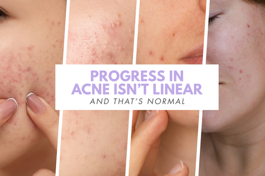 Progress in Acne Isn’t Linear (And That’s Normal)