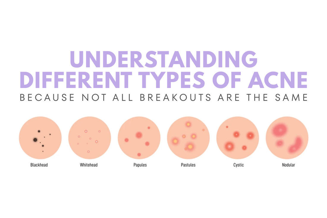 Understanding the Different Types of Acne (Because Not All Breakouts Are the Same)