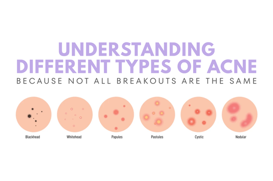 Understanding the Different Types of Acne (Because Not All Breakouts Are the Same)